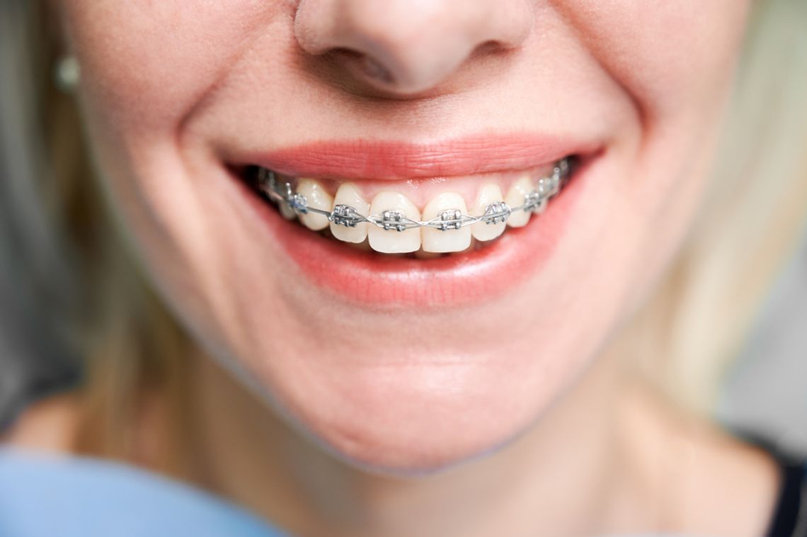 Wosk ortodontyczny w praktyce - wskazówki i sposoby użycia